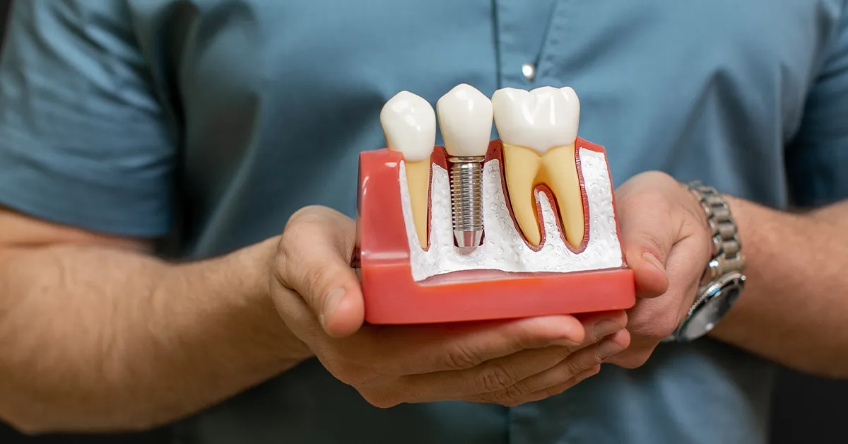 10 Reasons to Choose Dental Implants