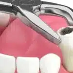 Extractions 150x150 1