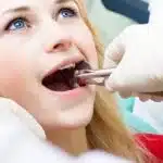 Wisdom Teeth Removal 150x150 1