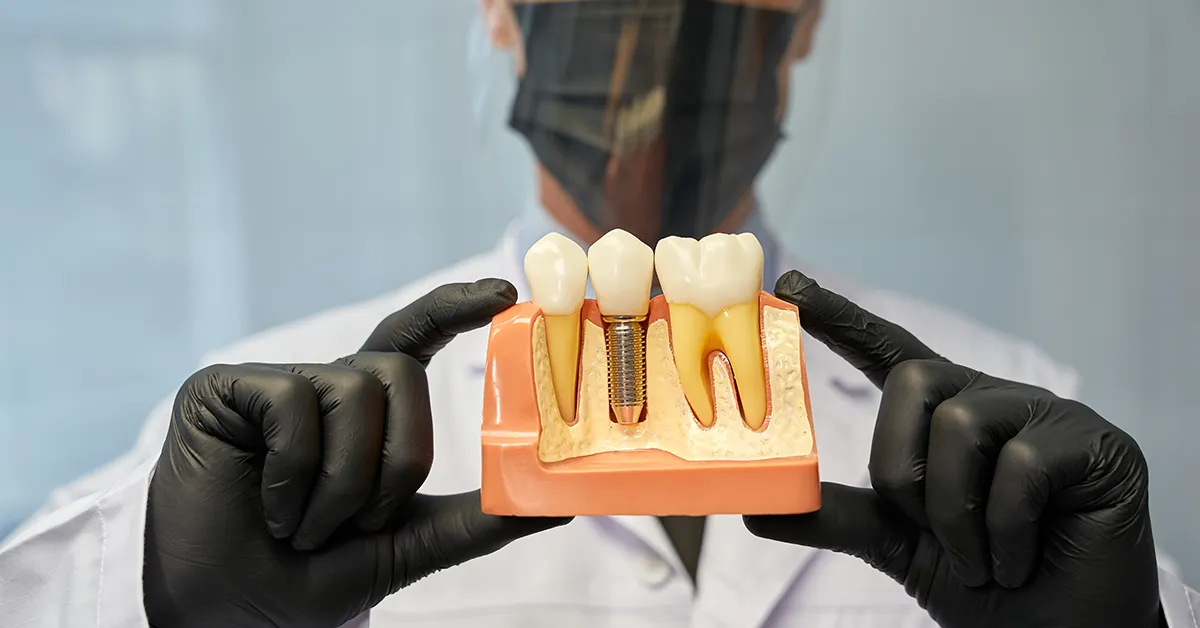 Dental Implants in Palm Coast Everything You Need to Know