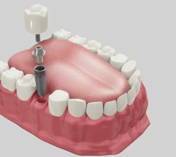 Get Dental Implants in Palm Coast