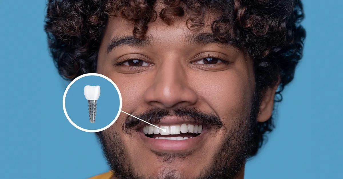 How much do dental implants cost