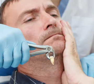 tooth extraction